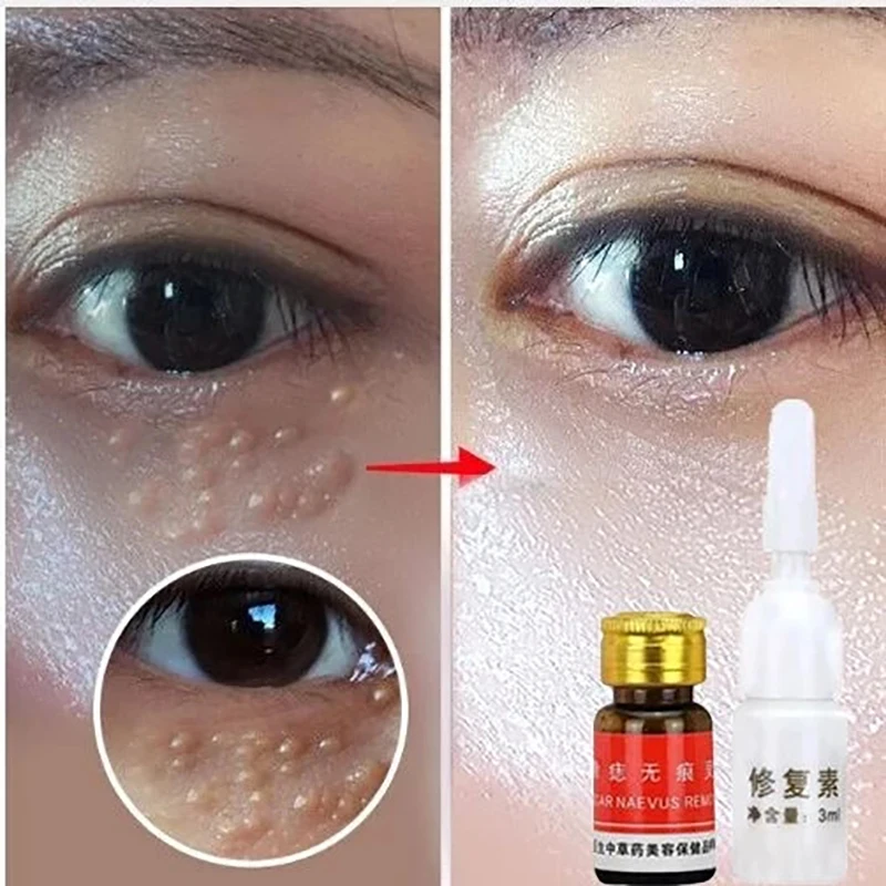 11g Removing Against Moles Remover Anti Verruca Remedy Liquid Pen Treatment Papillomas Removal Of Warts From Skin Tags |