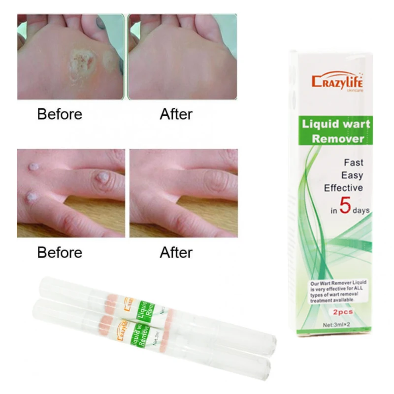 

Natural Health Skin Tag Remover 12 hours Tu kill Medical Tu kill Remover Skin Tag Mole & Genital Wart Foot Corn Remover 3ml