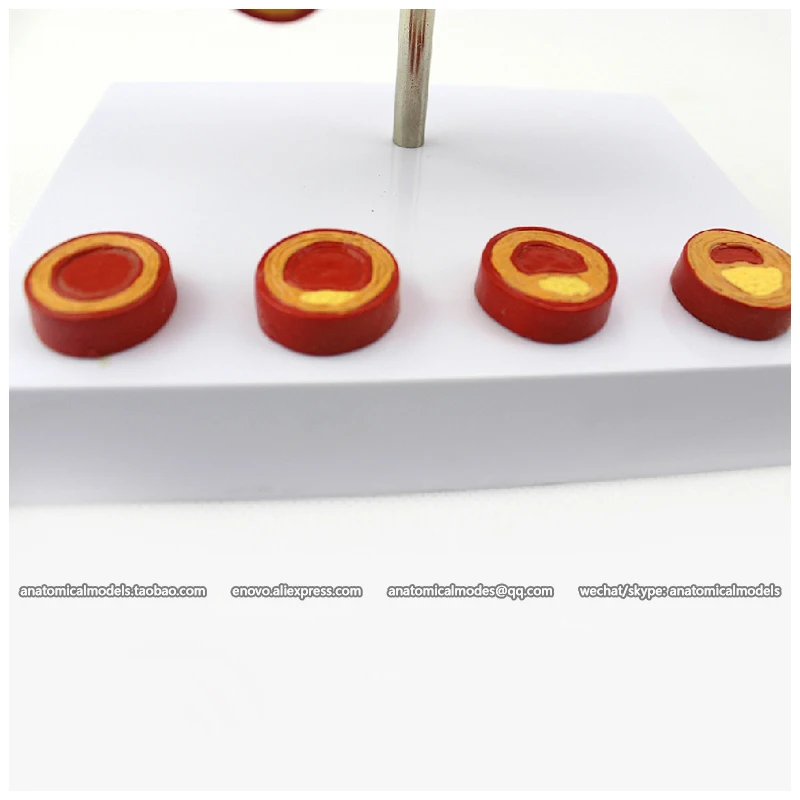 12482/модель крови для атеросклероза и тромбоза/CMAM медицинская анатомическая