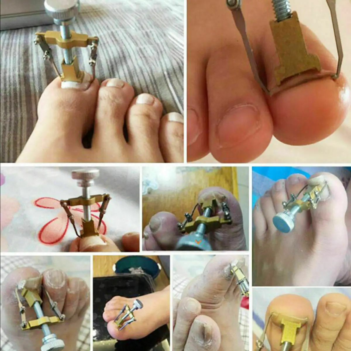 

Ingrown Toe Nail Recover Toenail Correction Pedicure Fixer Straightener Clippers Nail Tool Clipper