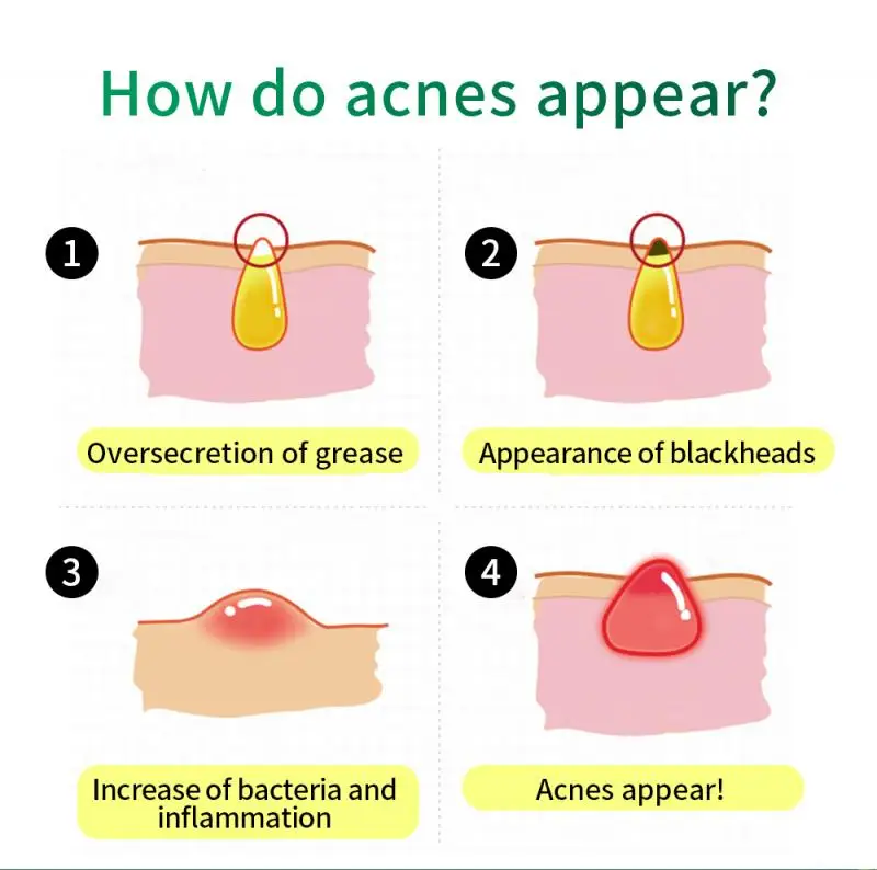 Крем для удаления акне от чайного дерева BREYLEE увлажняющий гель-эссенция женщин