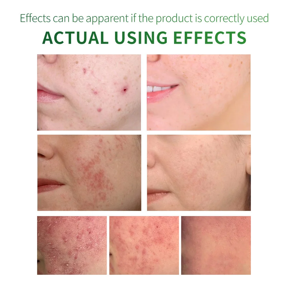 

2019 Anti Acne Removal Essence Remover Pimple Repair Shrink Pores Face Skin Care 40ml ZG88