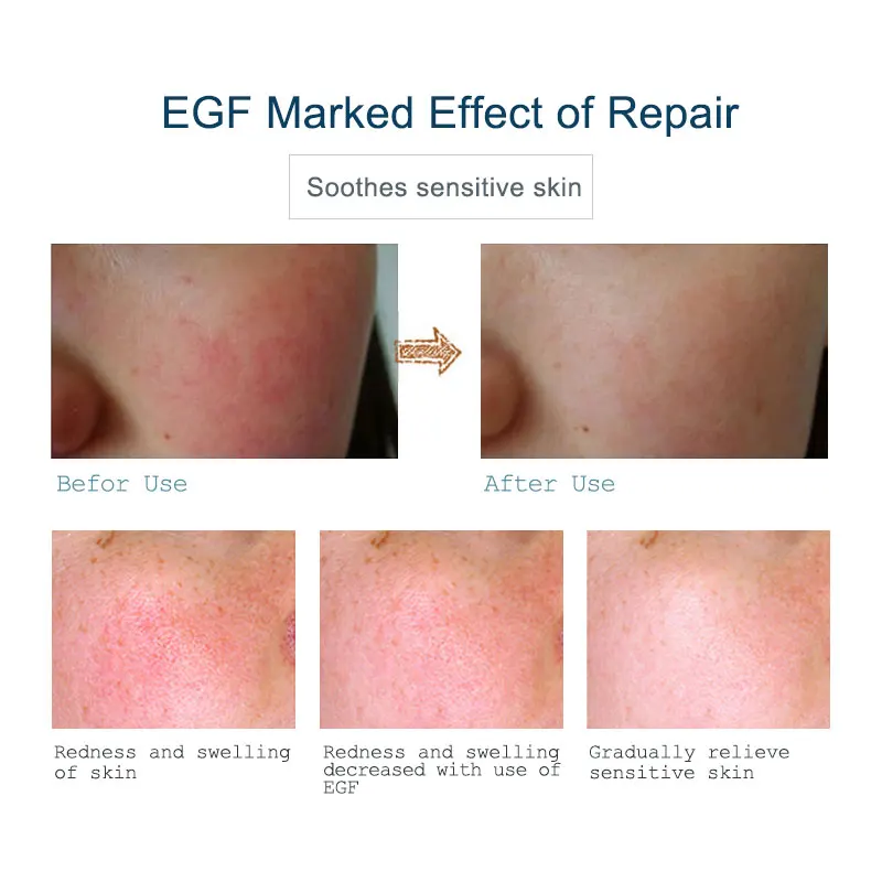 Купить 3 получить 1 подарок ARTISCARE ЭФР-сыворотка лечение акне угрей уход за кожей