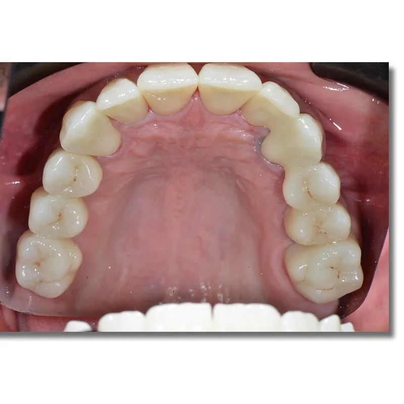 ST + Цвет OD98mm * 12/14 мм толщина Зубные имплантаты диоксида циркония пустой