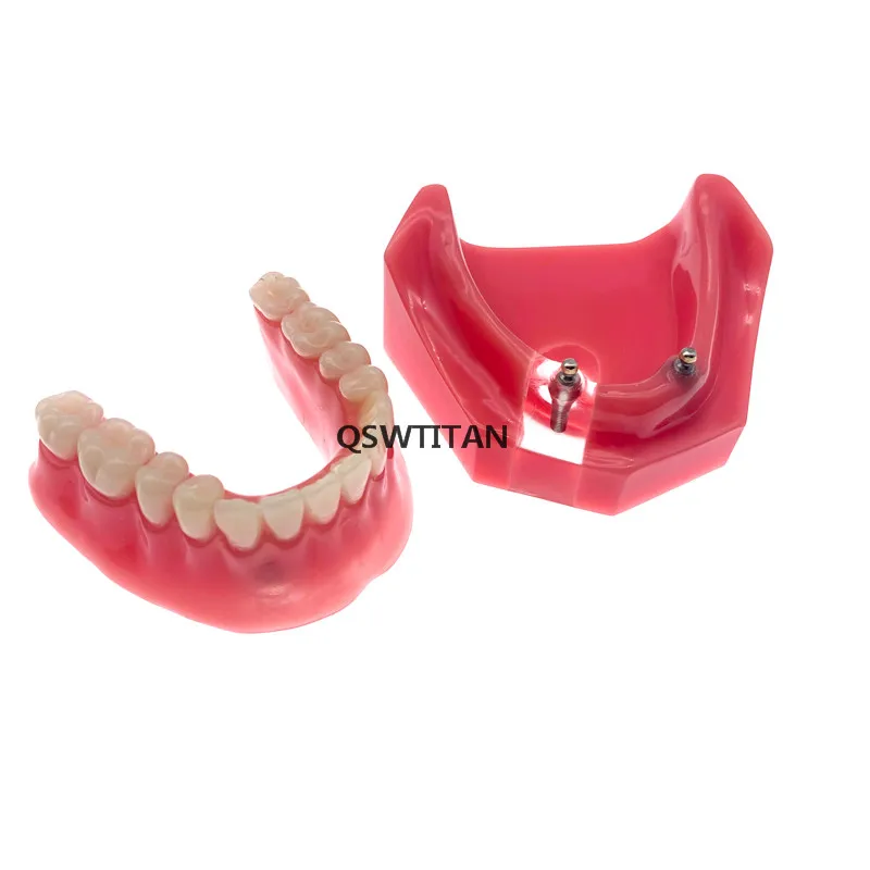 Стоматологическая уступает имплантат Overdenture 6007 модель зубов 2 импланты с