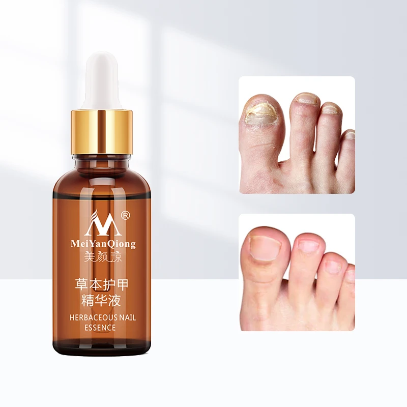 

Сыворотка для лечения Ногтей от грибков онихомикоз паронихия противогрибковая инфекция ногтей травяной гриб для ногтей восстанавливающая...