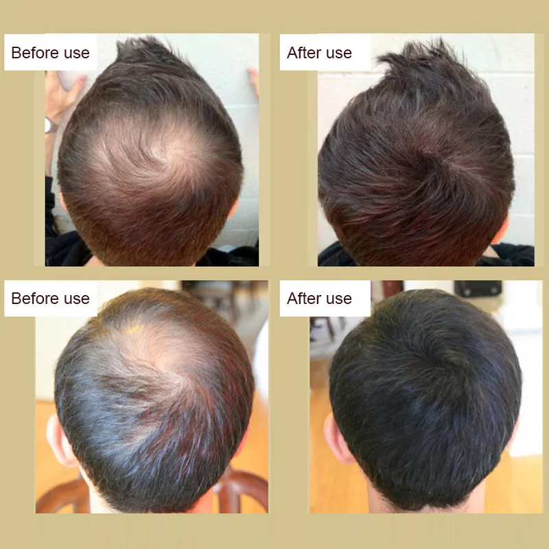 

Sevich Hair Growth Essence Oil Fast Powerful Liquid Treatment Essential Oil Hair Care MH88