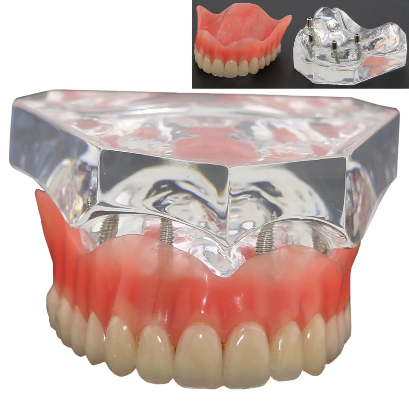 1 шт./упак. Dental Upper Overdenture Superior 4 имплантаты демо модель 6001 02