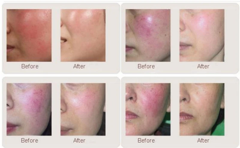 Аппарат для удаления сосудистой сетки 2 в 1 с диодным лазером 980 нм удаление