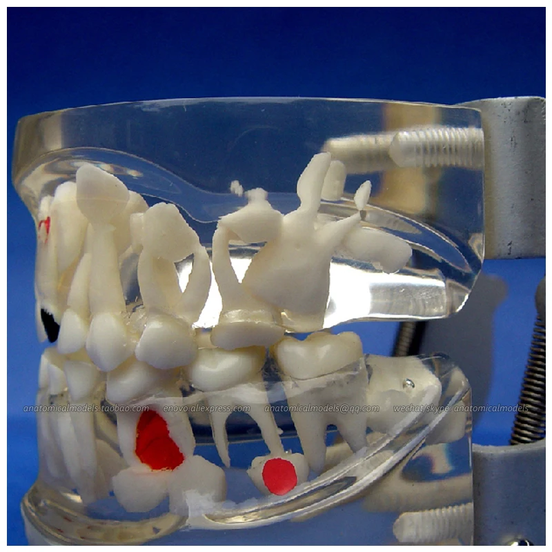 CMAM/12603 Dental- Dental caries in children, Human Oral Dental Medical Teaching Anatomical Model