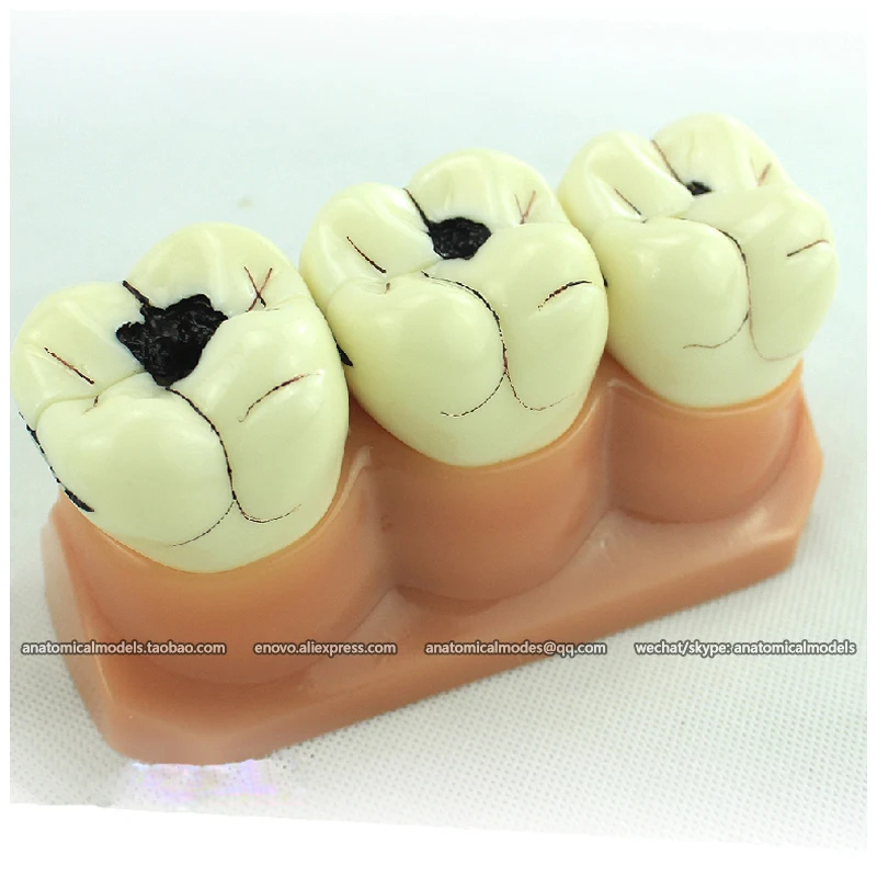 

12575 / Human Tooth Anatomy Dental Caries Model in 7 Parts, Medical Science Educational Teaching Anatomical Models