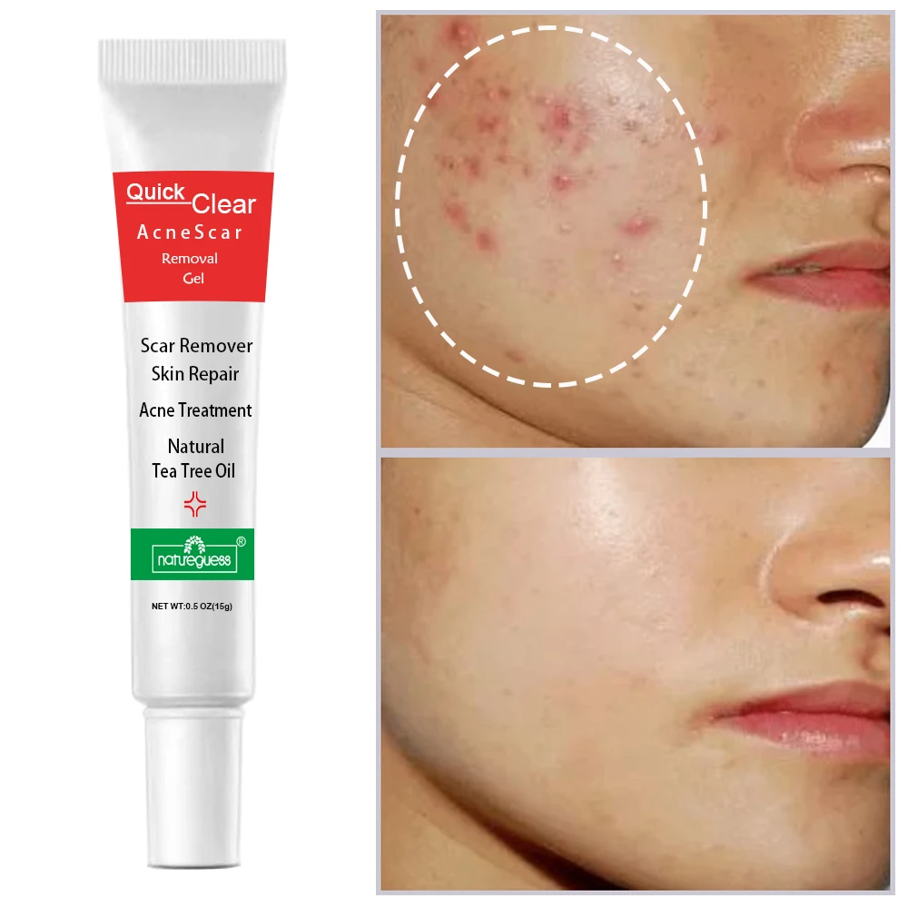 Крем для лица от акне шрамов черных точек контроль жирности сужение пор