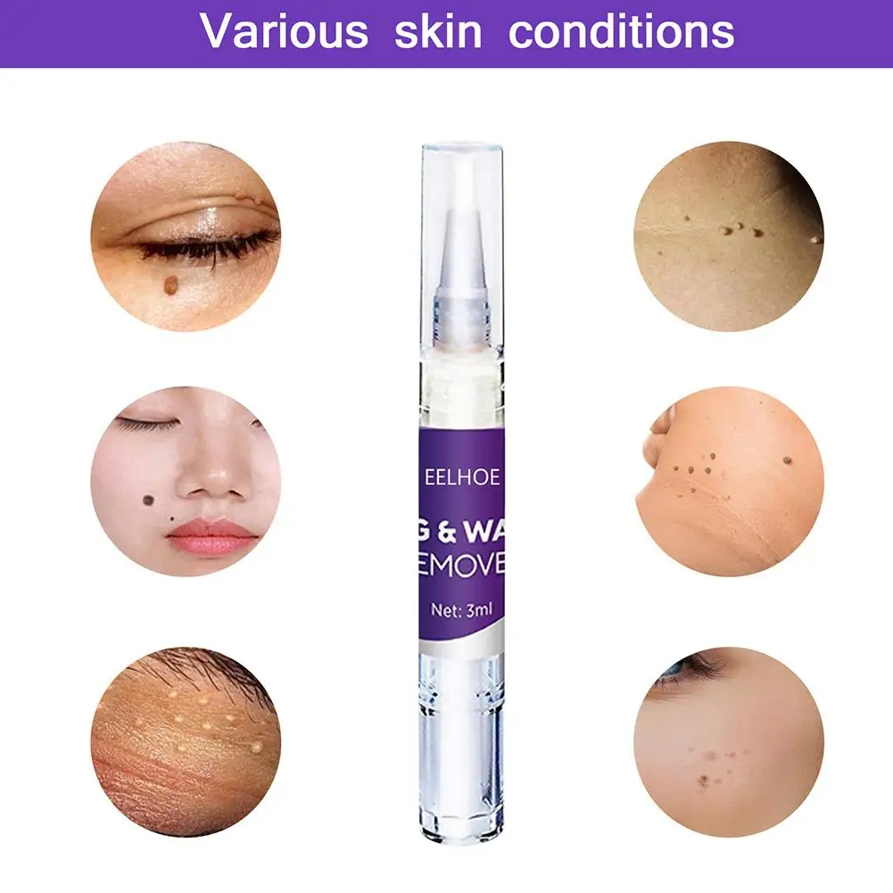 

3ml Skin Tag Remover Against Mole Genital Wart fast RemovWithin al Anti Foot Corn Removal Warts Papillomas Rapidly removes moles