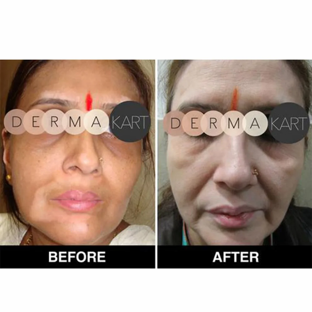 5 boxes India Original Mono benzo BB Bleaching Cream 20% Monobenzone Whitening Even Skin Tone Remove Melanin Spots 30g/box | Красота и