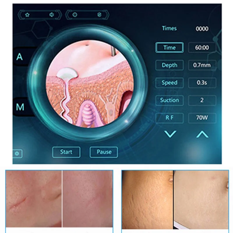 

2020 CE approved golden microneedle rf fractional micro needle beauty machine for skin resurfacing