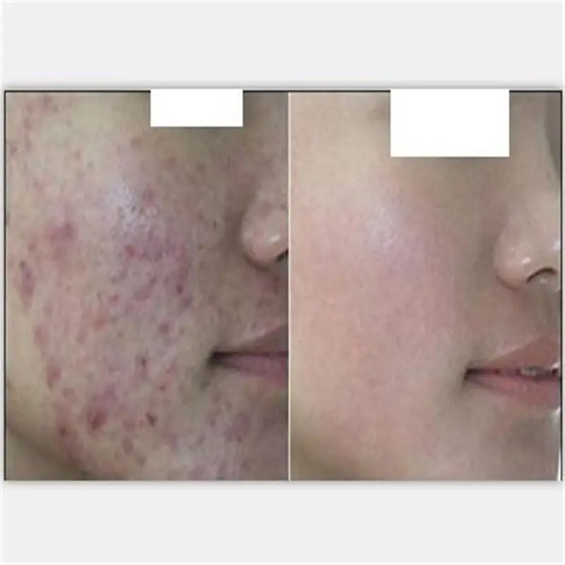 Следов от акне fade крем 3 шт./компл. удаление яма оспы гель алоэ вера и ремонт следов