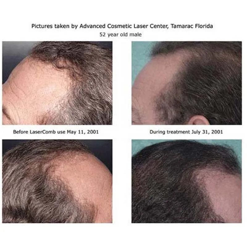 Массажная щетка для волос набор восстановления уход за волосами лазерный массаж