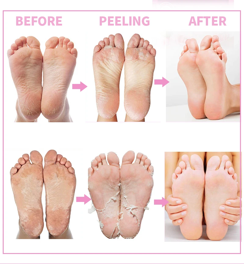 

2Pair Exfoliating Foot Mask Pedicure Socks Peel Dead Skin Exfoliation for Feet Mask Soften Heels Foot Peeling Mask for Legs