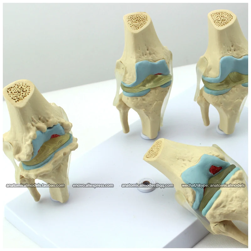 12359/человека 4-х ступенчатый остеоартрит колена комплект совместное Исследование