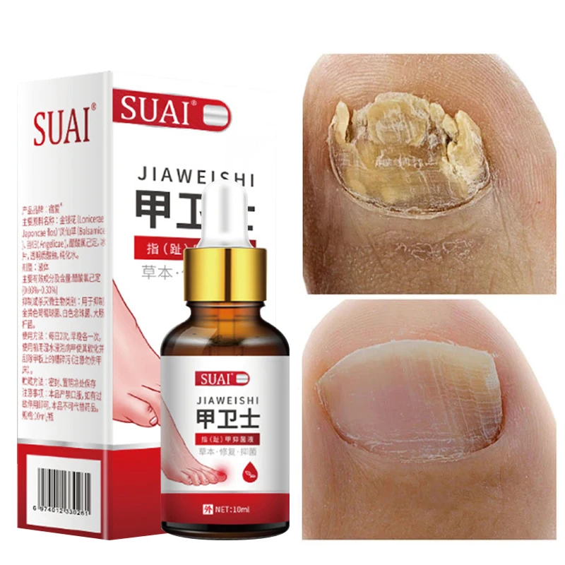 

Nail Fungal Treatment Feet Care Essence Nail Foot Whitening Toe Nail Fungus Removal Gel Anti Infection Paronychia Onychomycosis