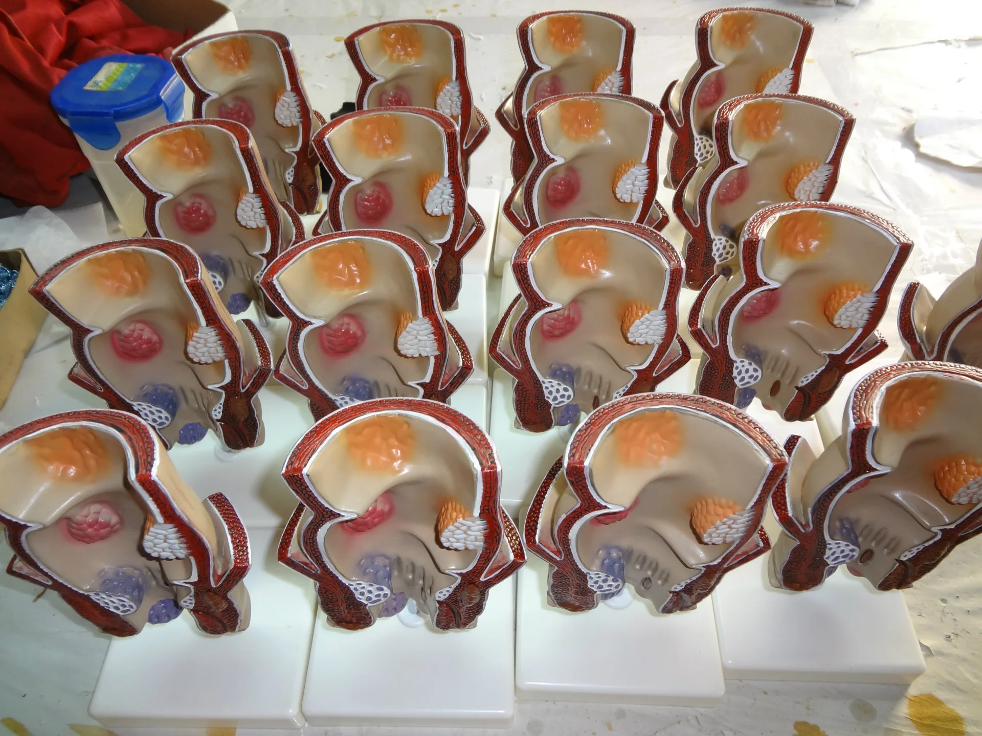 5-кратная анатомия человека модель поражения ректального геморроя внутренняя