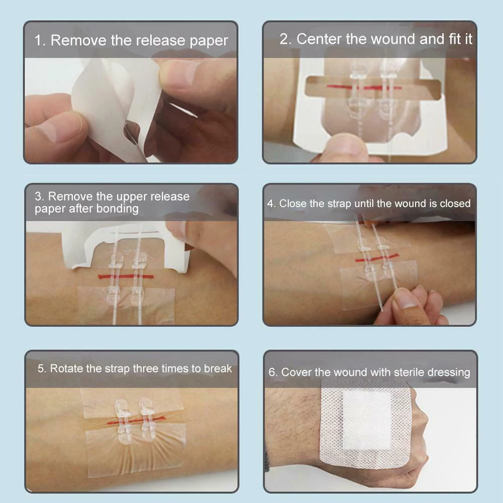 2/4/12 PCS Zipper Band-Aid Suture Fast Stitch 7x6cm Personal Health Care Braces & Supports TK-ing | Красота и здоровье