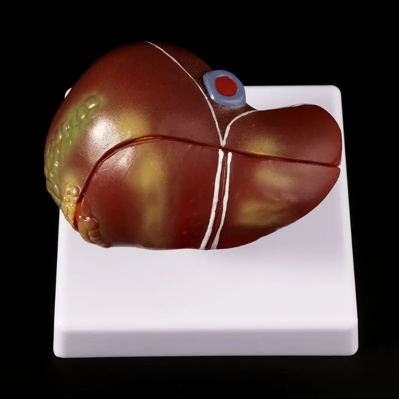 

1 PC Human Liver Pathology Model Pathological Anatomical Model Anatomy School Medical Teaching Display Tool Lab Equipment