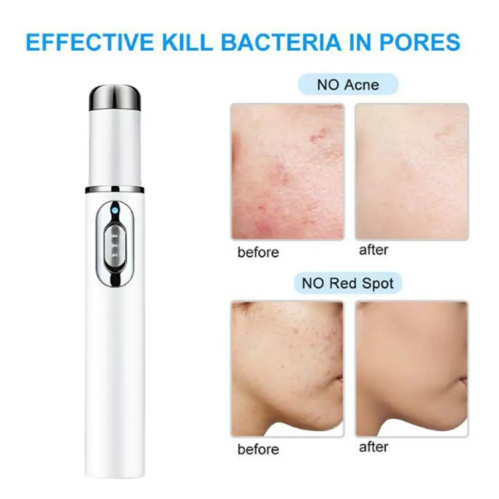 

KD-7910, синий светильник, ручка для прыщей, мягкий шрам, удаление морщин, ластик, устройство, портативный массаж, расслабление