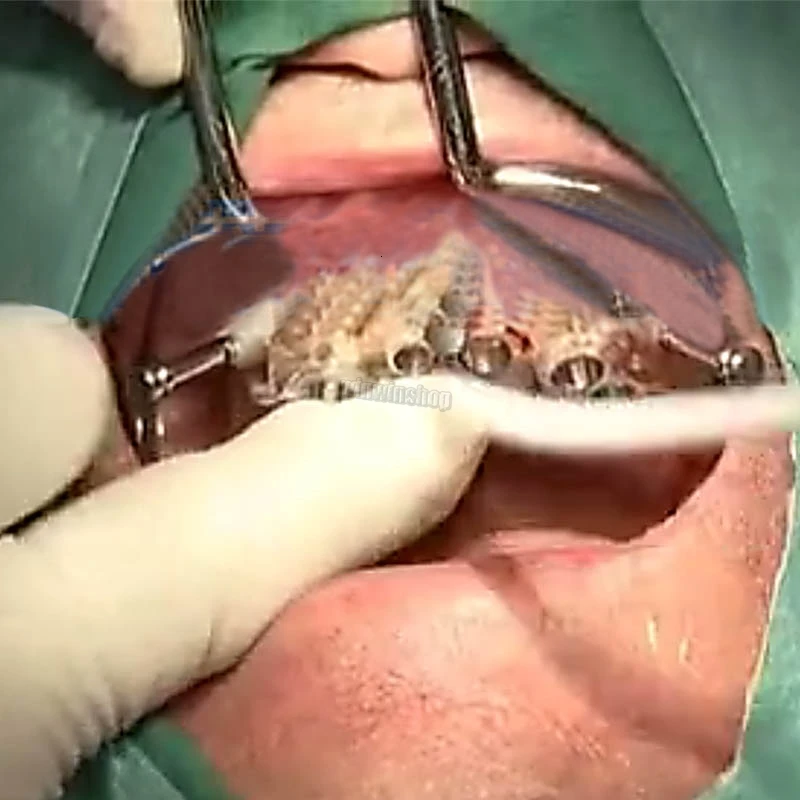 Большой загубник для имплантата 8 см стоматологический аппарат стоматологии