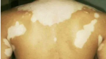 

50ml White spot Urticaria special liquid Eliminate white spot Sweat spot External face body