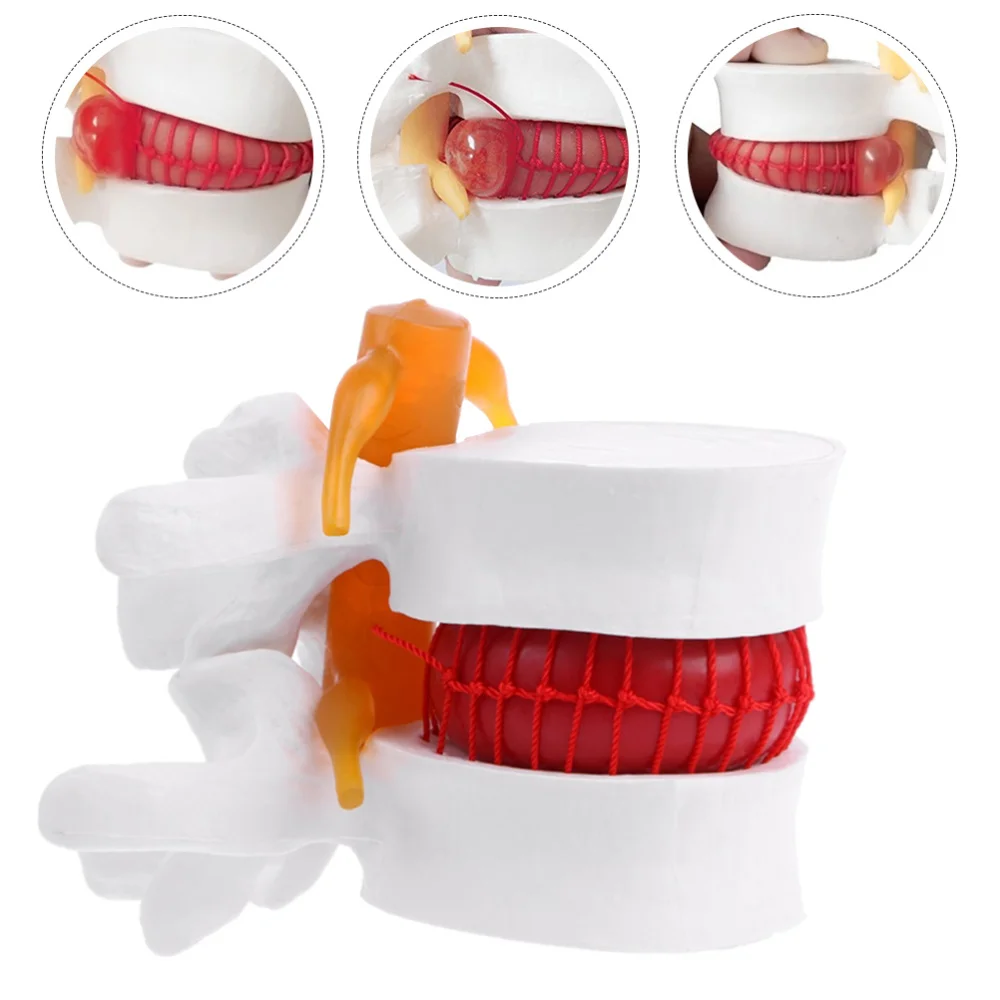 

1pc Human Spine Model Lumbar Disc Herniation Presentation Model for School