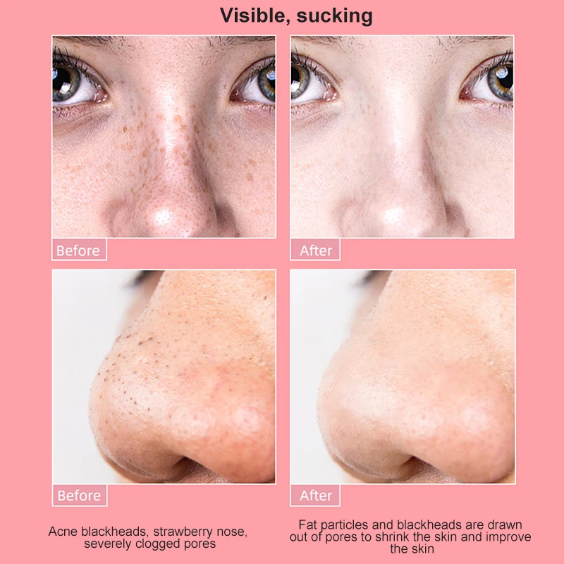 

USB Visual Face Blackhead Remover Pores Black Spot Cleaner Suction Pore Acne Pimple Skin Care Facial Nose Cleaner Beauty Tool