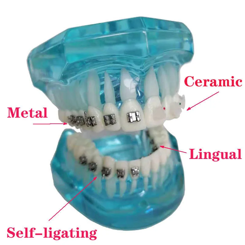 1 Piece Dental Teeth Model Orthodontic 4-type Brackets Contrast Metal/Ceramic/Lingual/Self-ligating