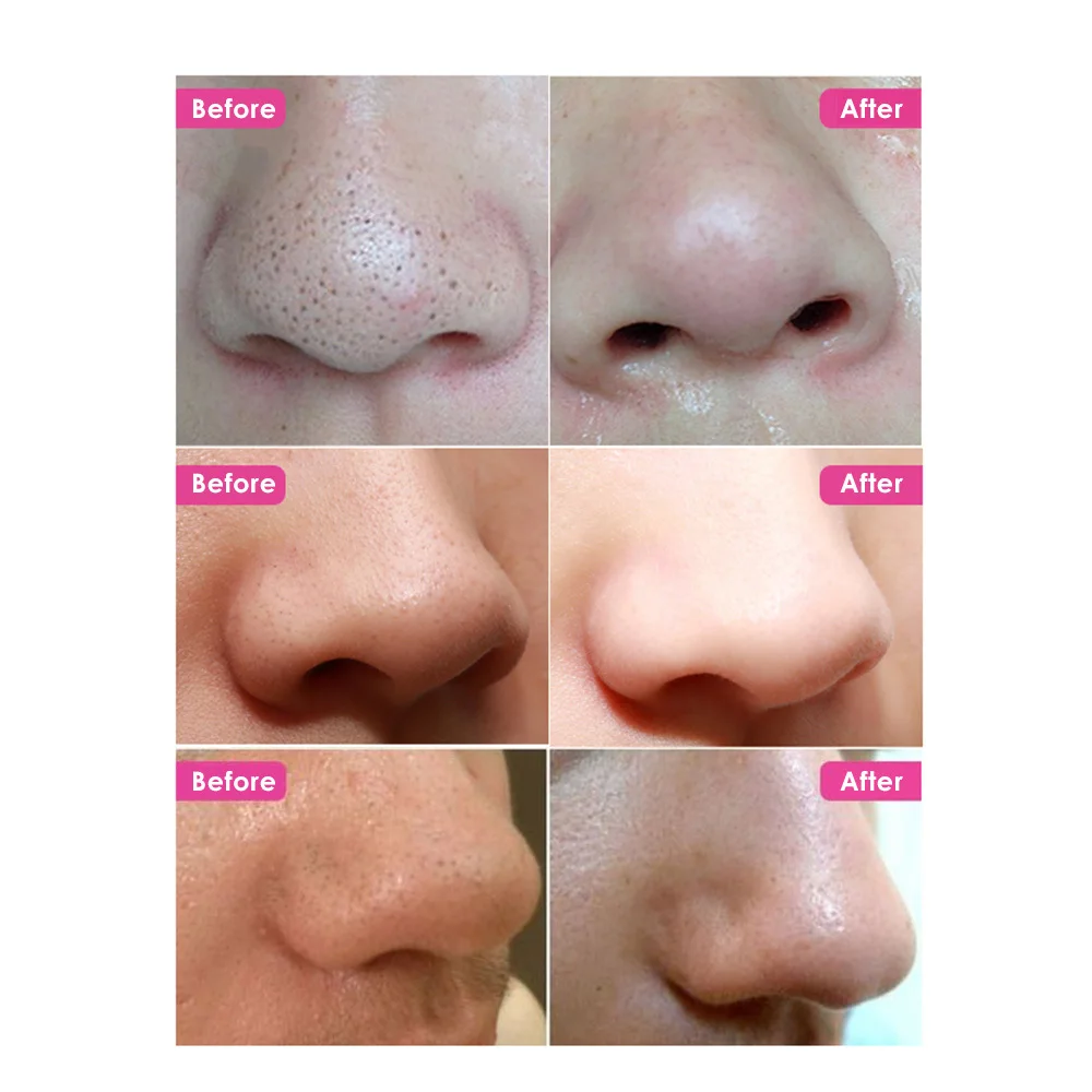 5 шт. очистка пор на носу с бамбуковым углем черным и белым цветом|Средство для