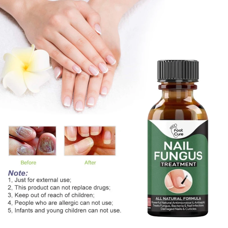 

Fast Fungal Nail Treatments Remove Onychomycosis Paronychia Anti-Fungal Nail Toe Fungus Repair Care Essences Nail Treatments