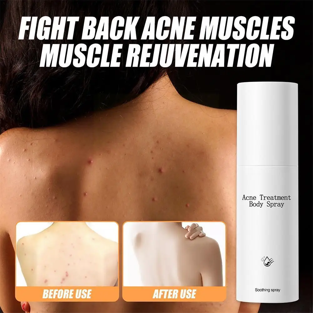 

100ml Body Acne Spray Antibacterial Spray Antipruritic Pruritus Relieve Care Body Dermatitis New Acne Skin Itch Spray Treat E2b9