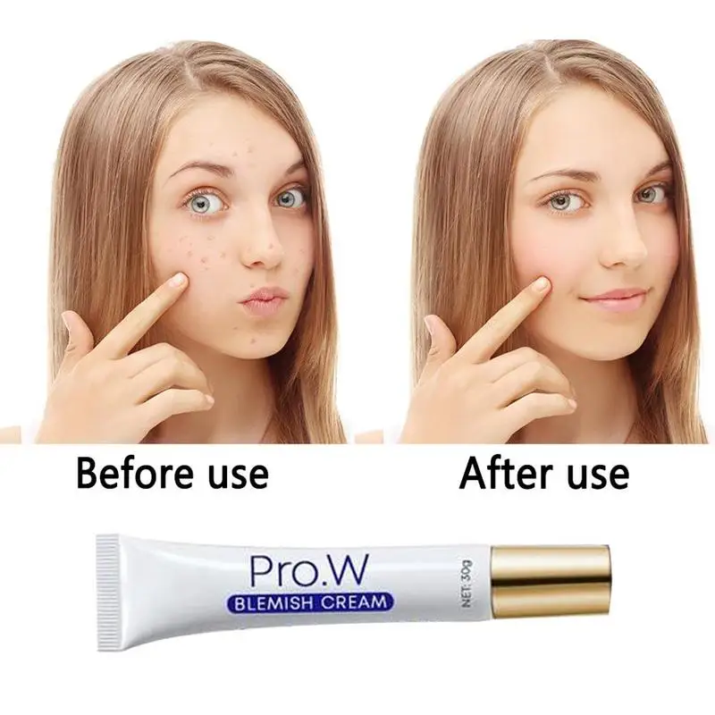 Extract Acne Scar Removal Cream Wounds Scars Stretch Treatment Marks K8D0