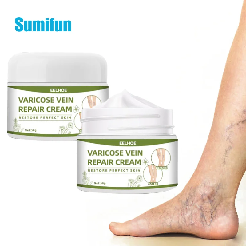 Крем для лечения варикозного расширения вен удаление паука на бедра