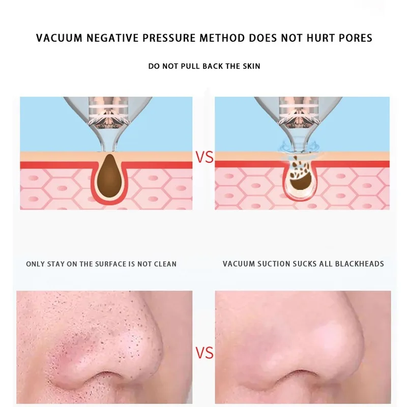 Косметический аппарат для удаления черных точек угрей вакуумный очистки пор