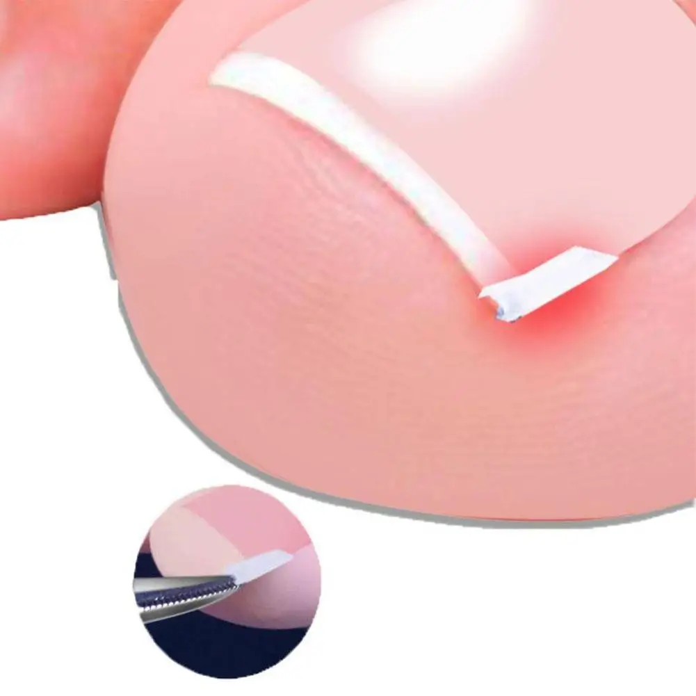 

Ingrown Toe Foot Nail Correction Sticker Pedicure Tool Toenail Toenail Corrector Pad Paronychia Corrector Orthopedic I0O4
