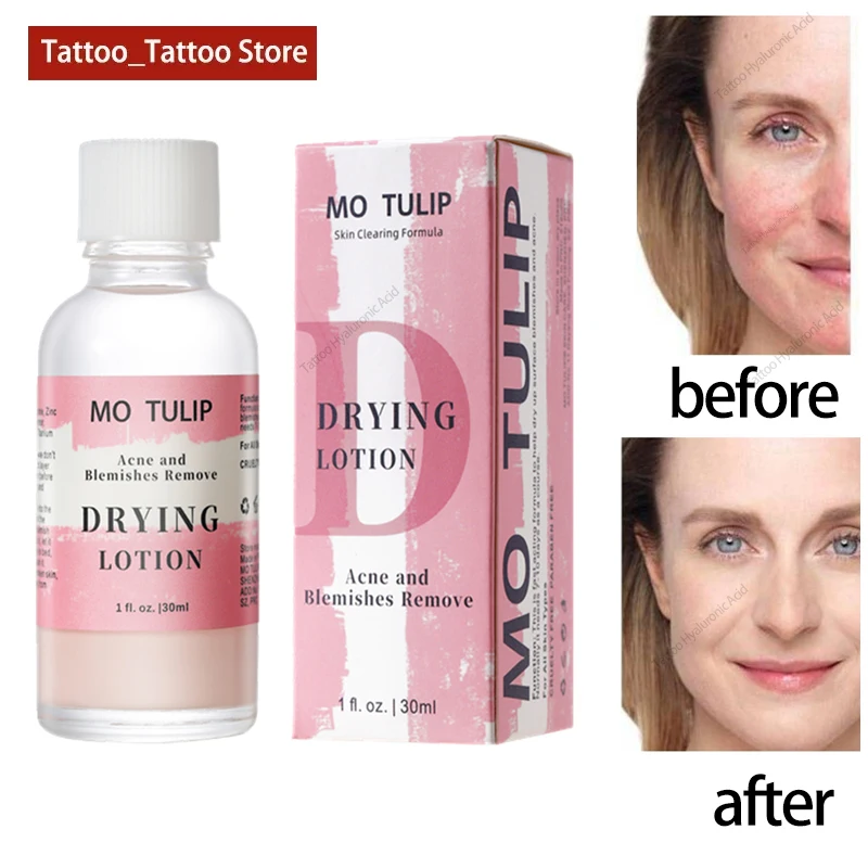 

MO TULIP 30ml Effective Squeezer Acne Treatment Mario Badescu Drying Lotion Face serum Anti Acne Serum Pimple Blemish Removal
