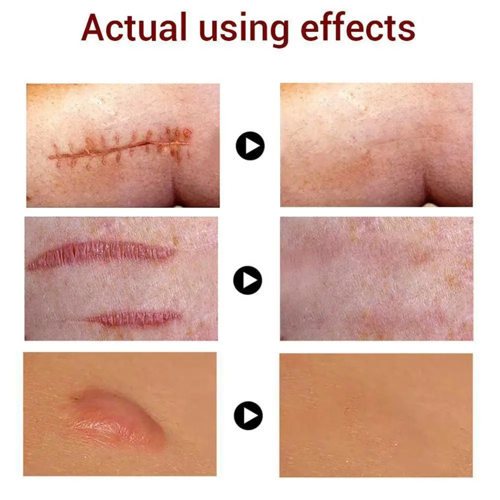 Scar Repair Cream Acne Treatment Face Blackhead Repair Moisturizer Whitening Skin Pores Care Oil Control Gel Shrink Scar M0Z1