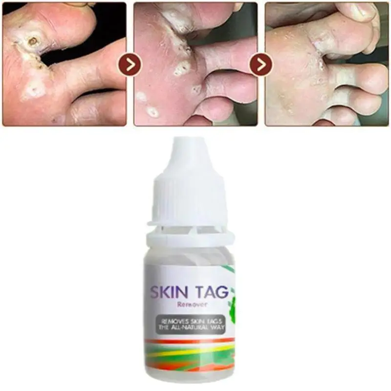 

Wart removal liquid Corn husk removal for feet Wart treatment cream Herbal extracts Medical plasters