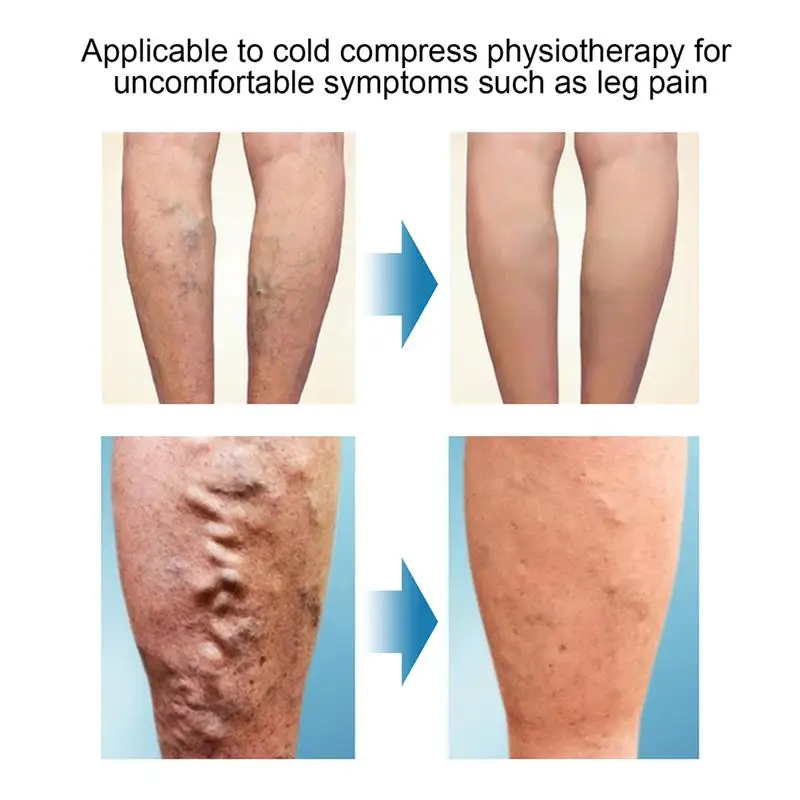 Набор для лечения варикозного расширения вен набор крем и ручка сисветильник |