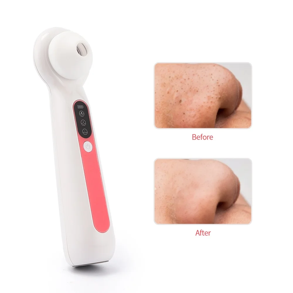 Лупа для визуального вакуумного удаления угрей уход за кожей прыщи Удаление пор