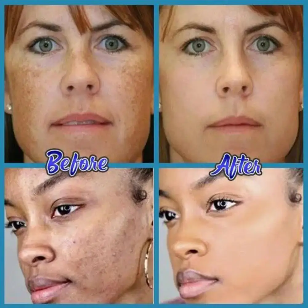 

Natural Herbal Topical Cream Acne Whitening Freckle Care Cream Acne Cream Cream Moisturizing Skin Cream Acne Freckle W1T8