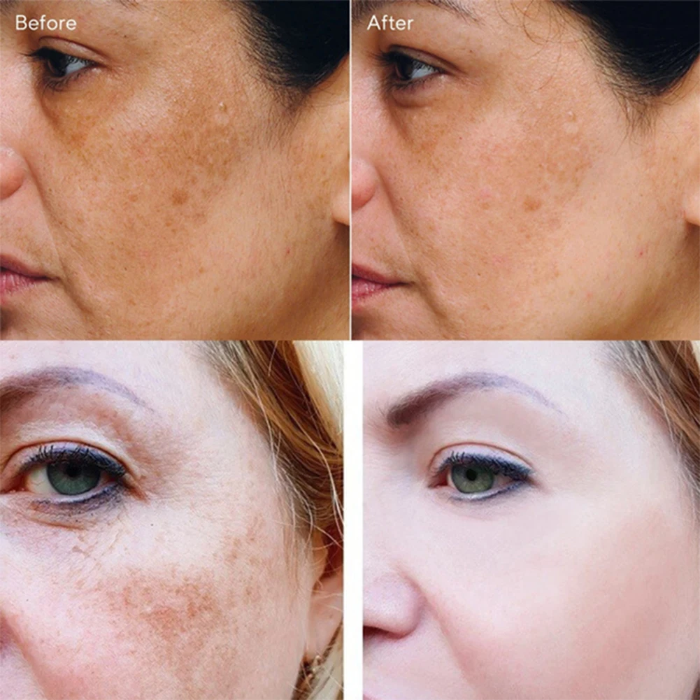 

Effective Remove Melasma Acne Spot Pigment Melanin Dark Spots Pigmentation Whitening Freckle Cream Moisturizing Gel
