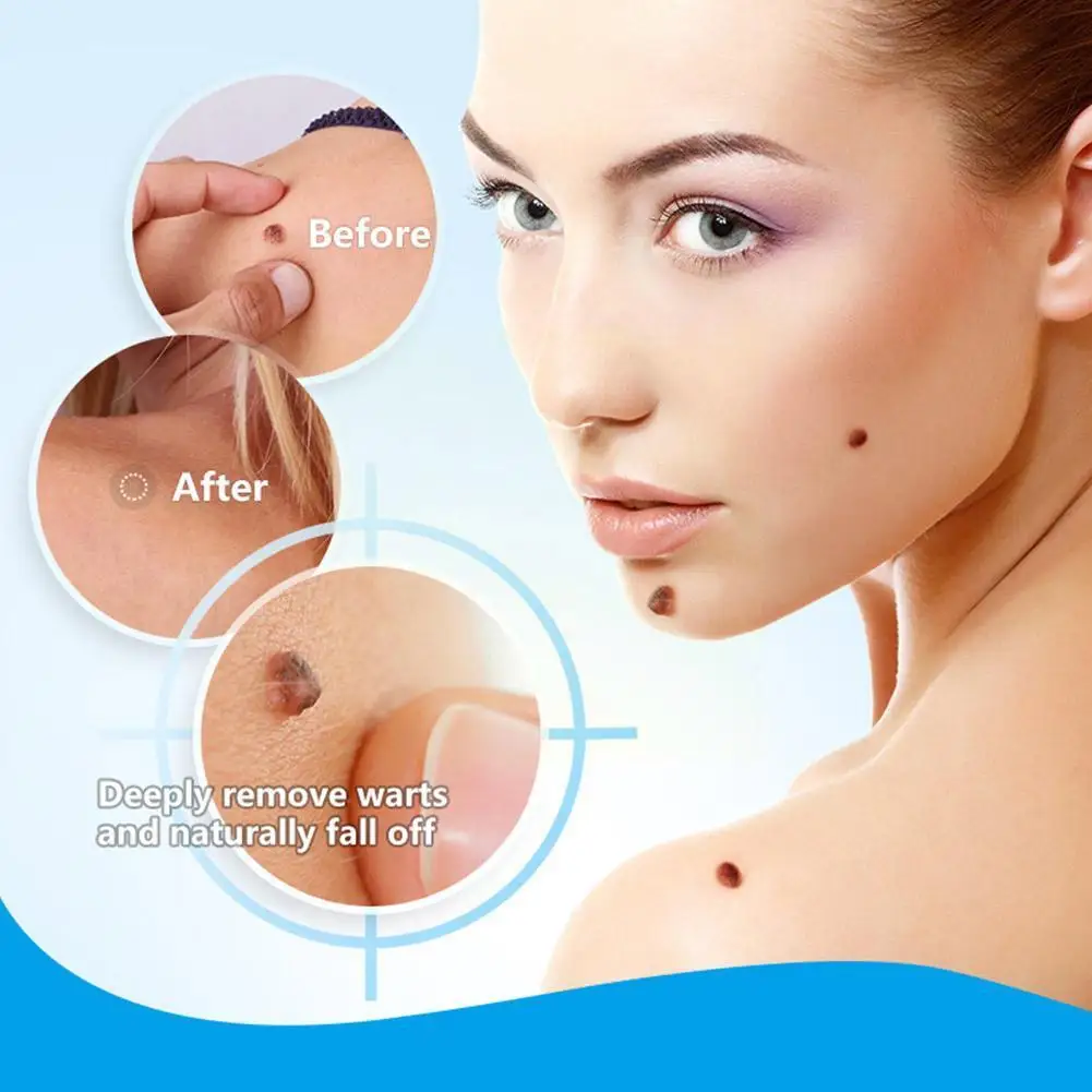 Крем для бородавок антибактериальный крем удаления микро мазь уход за мужями