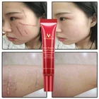 Крем для удаления шрамов после акне MYQ, восстанавливающий крем для лица, Лечение пятен после акне, отбеливающий крем против шрамов, растяжек и черных точек