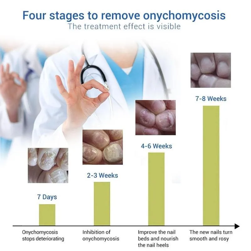 Nail Fungal Treatment Feet Care Essence Nail Foot Whitening Removal Anti Toe Gel Paronychia Fungus Infection Nail Onychomyc B8C4